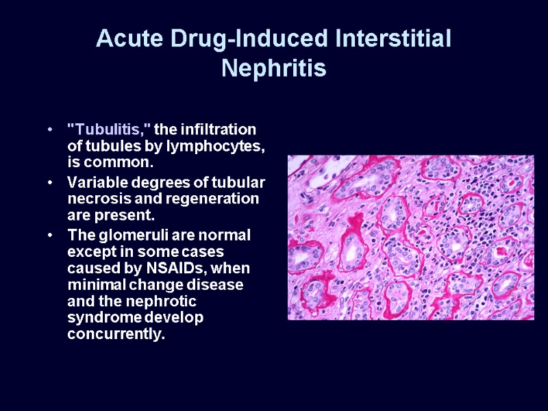 Acute Drug-Induced Interstitial Nephritis 